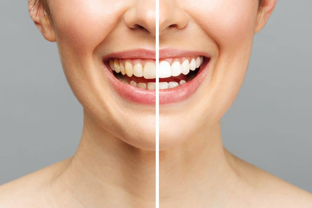 Zahnverfärbungen beseitigen